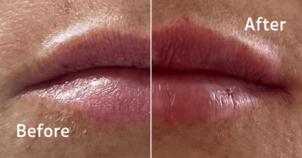 lip filler before and after in Cardiff aesthetic clinic